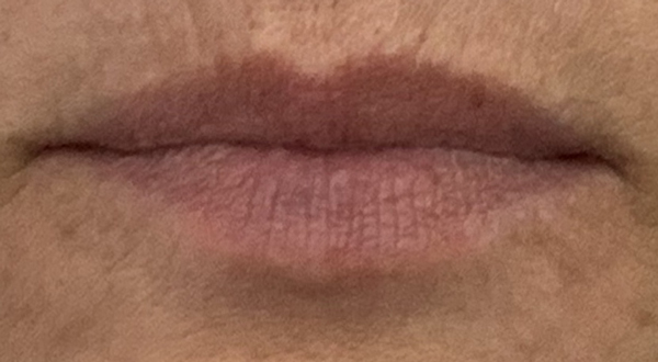 Botox and
              Juvederm®