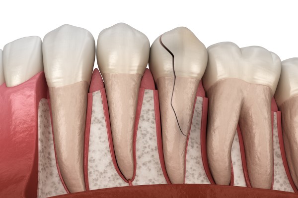 Get A Broken Tooth Treated To Avoid Complications