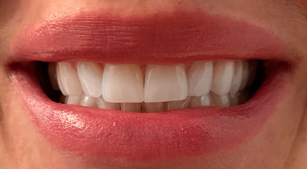 Botox and
          Juvederm®