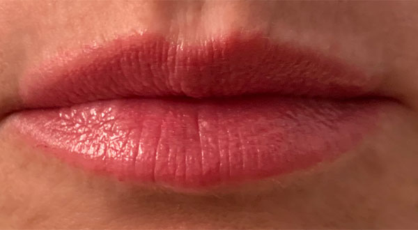 Botox and
          Juvederm®
